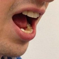 رابطه بوی بد دهان با سرطان مری رابطه بوی بد دهان با سرطان مری